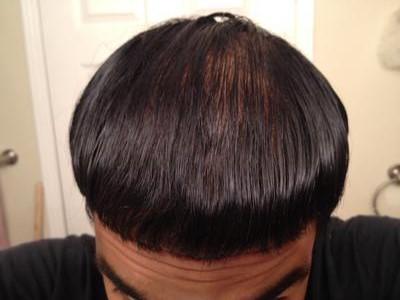 before-and-after-hair-regrowth-pictures-progress-after-3-12-months-21752748.jpg