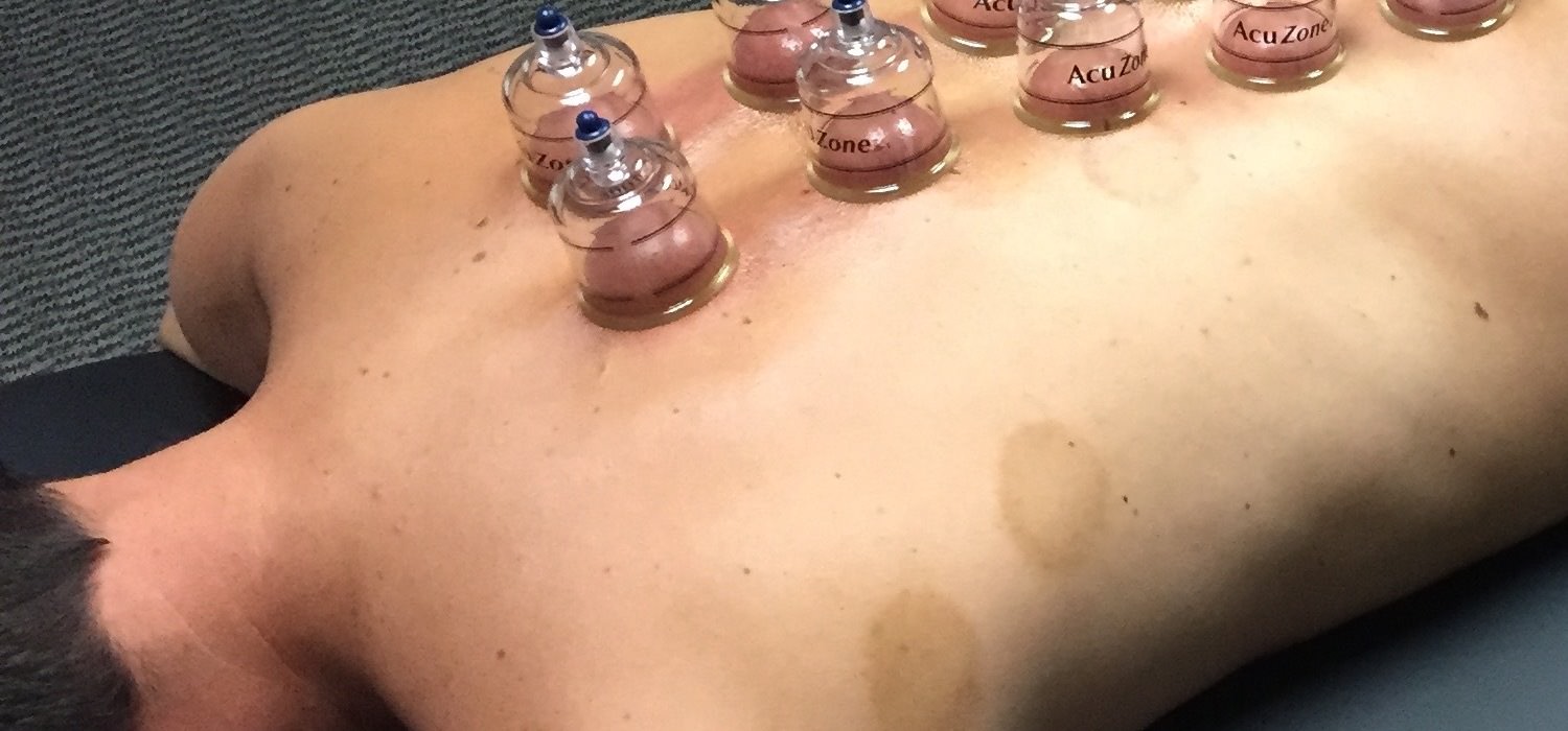 therapeutic-cupping-featured.jpg
