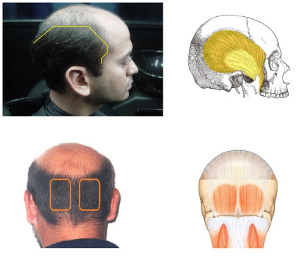 alopecia2.jpg