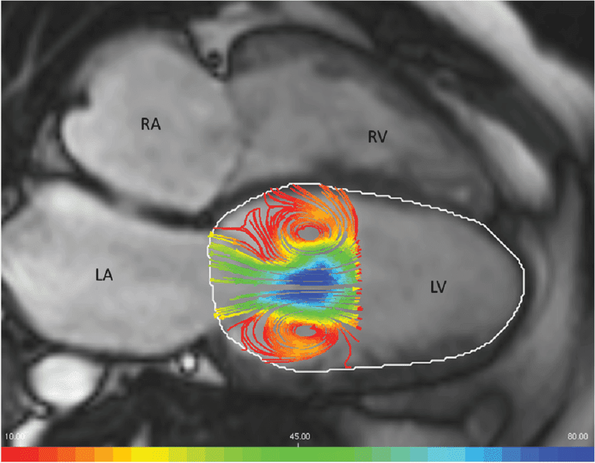 Figure-12-2D-view-of-an-early-filling-vortex-ring-flow-in-the-left-ventricle-LV.png