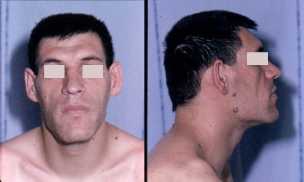 Facial-aspect-of-a-patient-with-acromegaly-The-nose-is-widened-and-thickened-the.png